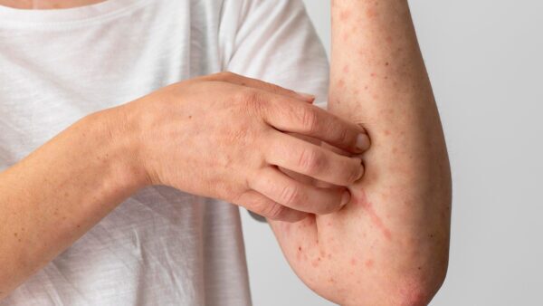The Connection Between Hypermobility and Autoimmune Disease