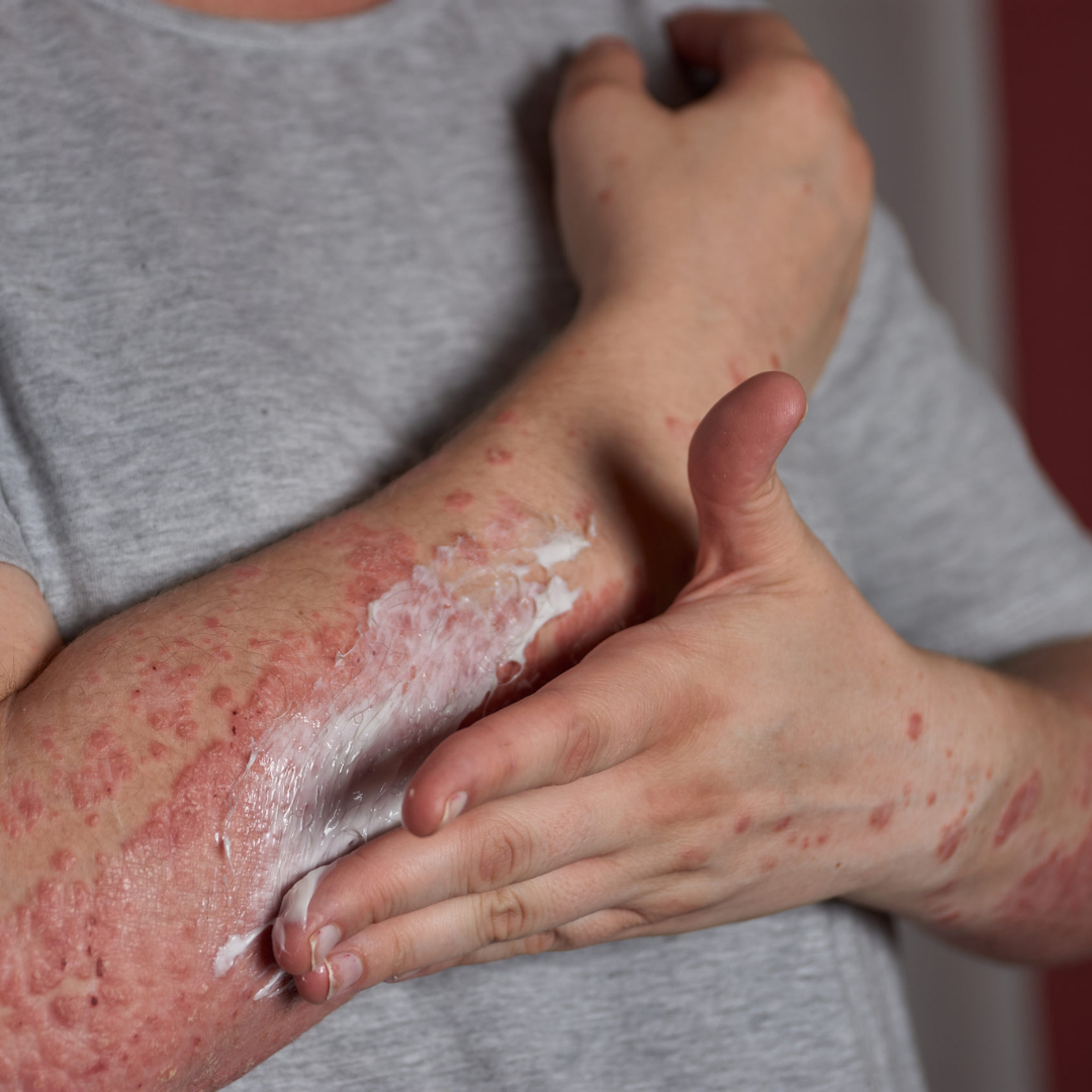 bpc 157 for autoimmune I use BPC-157 regularly with autoimmune patients,